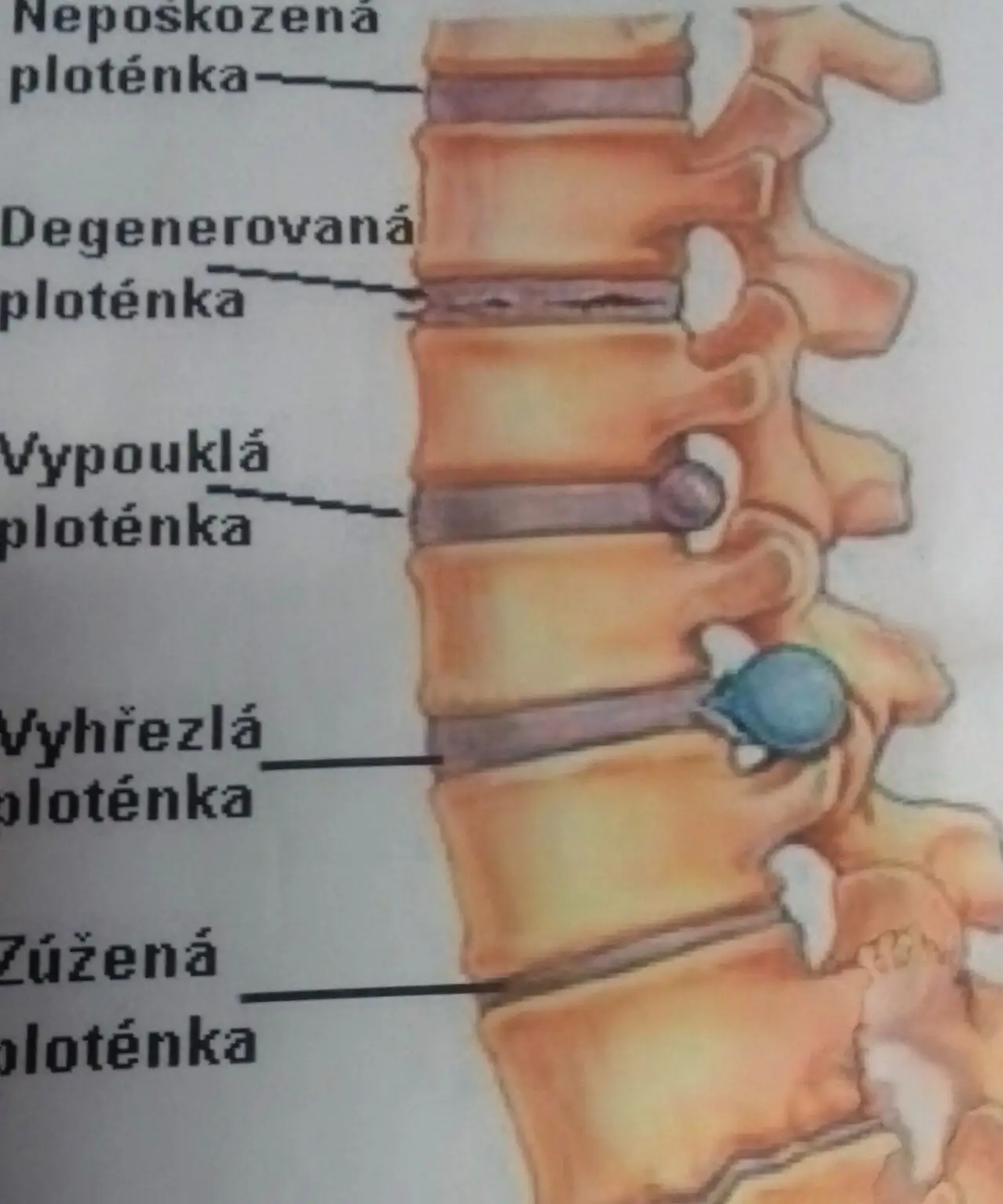 nemoc, bolest, utrpení versus ploténky